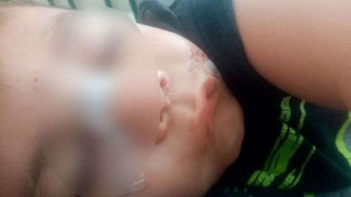 Nene fue atacado por un pitbull en la cara: tuvieron que hacerle 40 puntos