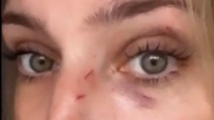 Dani la Chepi con heridas en su rostro: “estaba durmiendo y me atacó"
