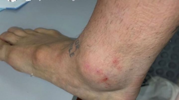 Impactante foto: así quedó el tobillo del Papu Gómez tras el partido con Chile
