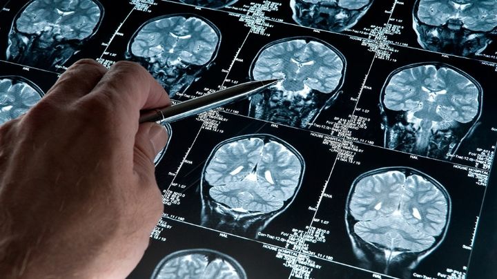 Un test busca detectar el Alzheimer 3 años y medio antes del diagnóstico clínico