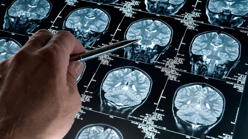 Un test busca detectar el Alzheimer 3 años y medio antes del diagnóstico clínico